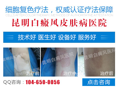 患上白癜风后平时改怎么护理?