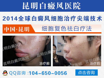 为什么会有那么多的人患上白癜风?