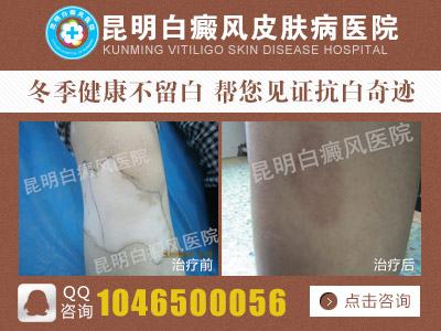 白癜风跟白化病有什么区别?