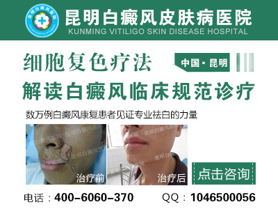 什么是完全性白癜风?
